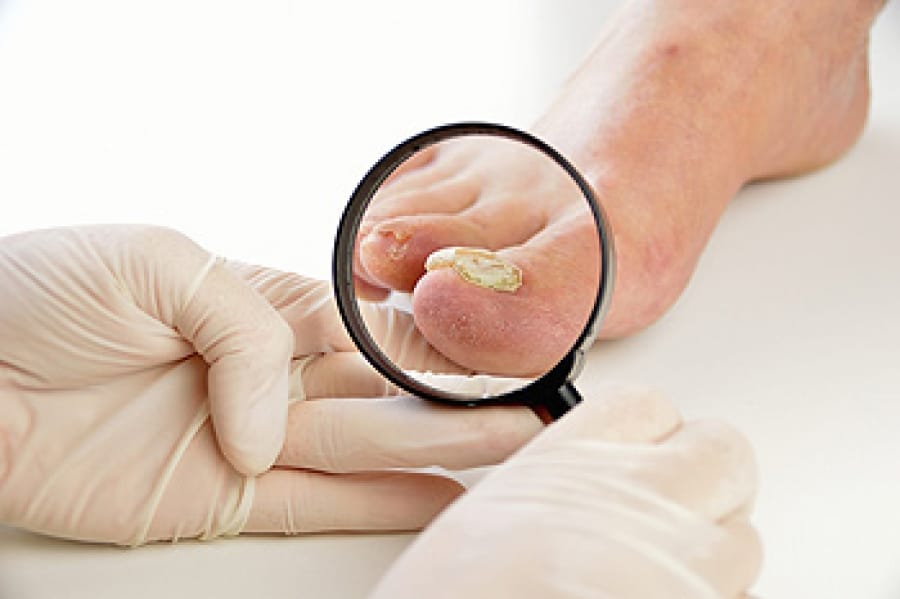 What factors increase the risk of toenail fungus?