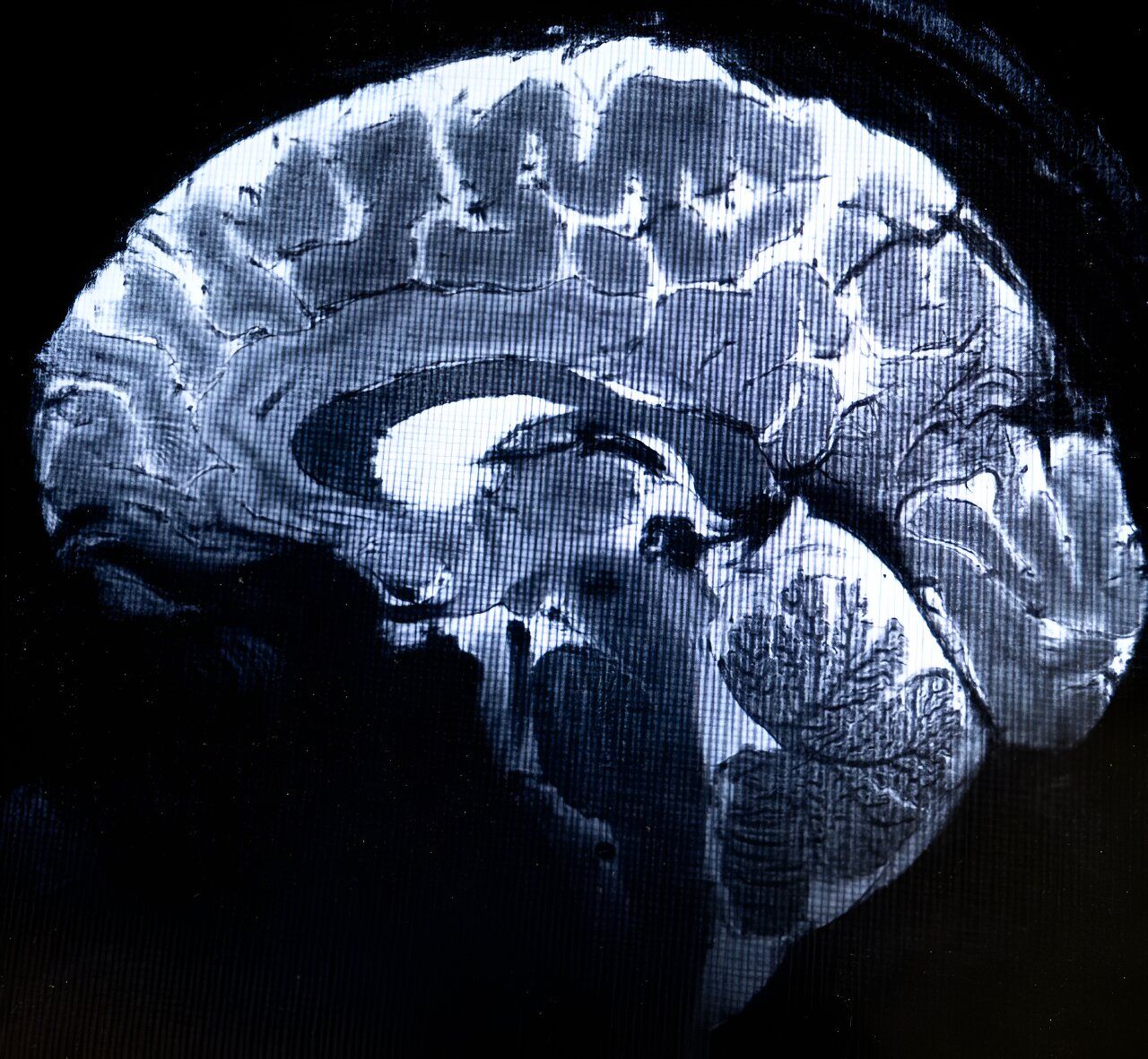 What is Iseult? The world's most powerful MRI scans first images of the human brain