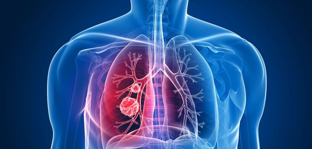 Scientists in the UK developing the world's first lung cancer vaccine