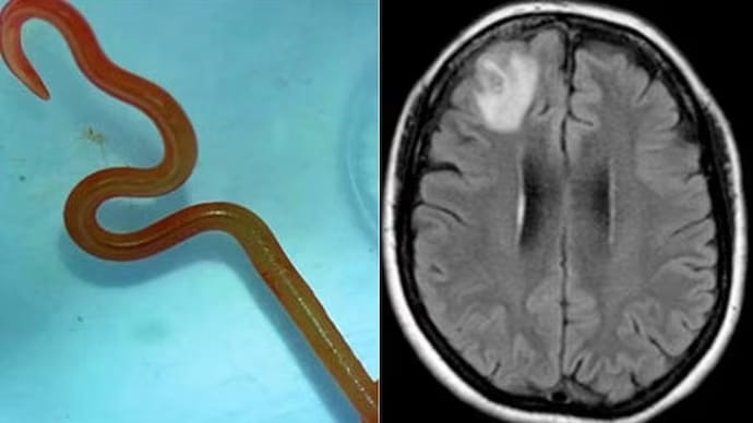 How did the worm, usually found in pythons, enter a woman's brain in Australia?
