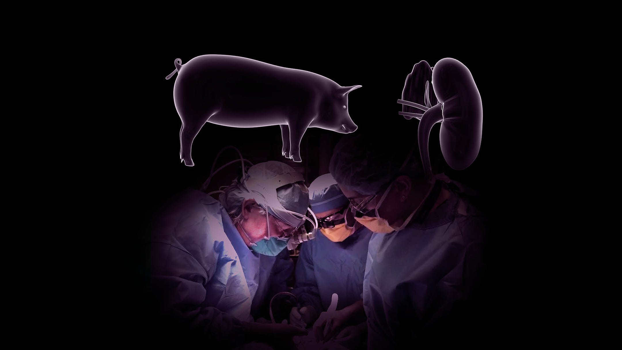 Kidney Transplant pig to human