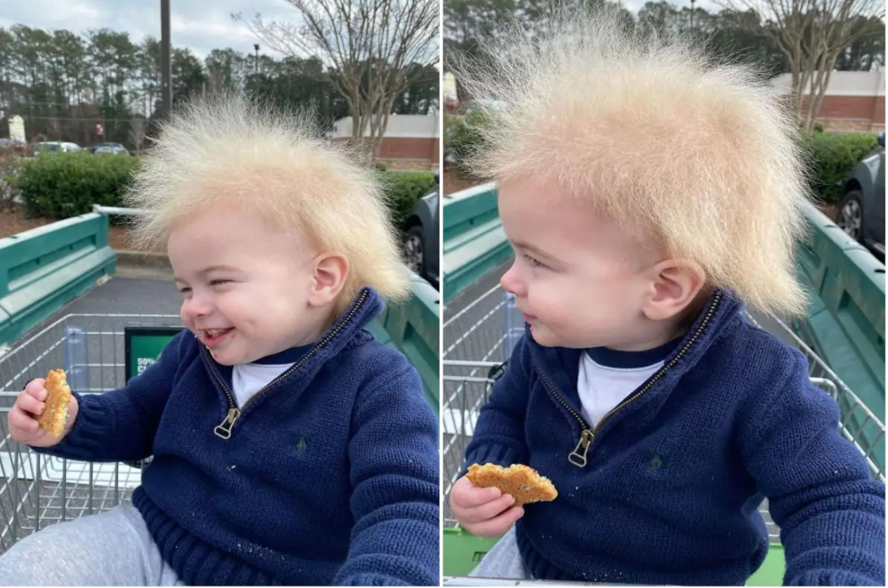 Uncombable hair syndrome: Toddler diagnosed with a rare genetic condition