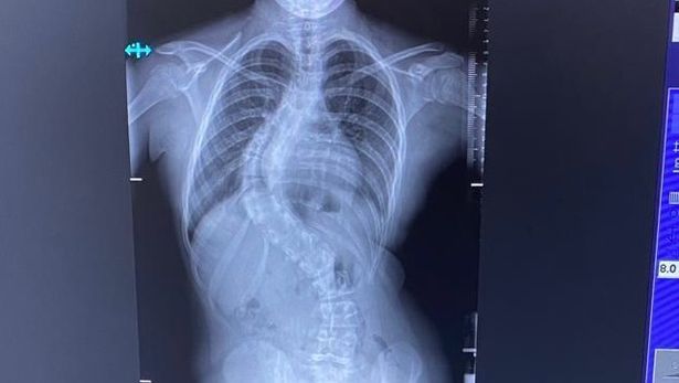 spine curved