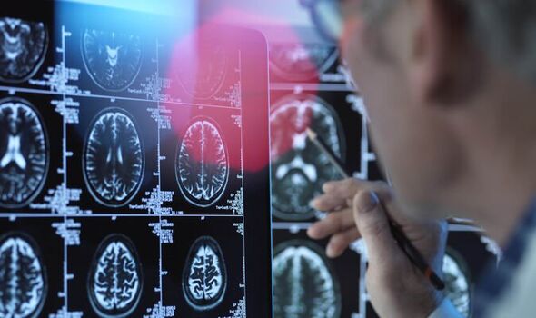 Study reveals 42 new genes associated with Alzheimer’s disease￼