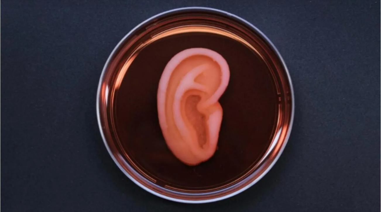 In a first, a patient receives 3-D printed ear implant made from her own cells