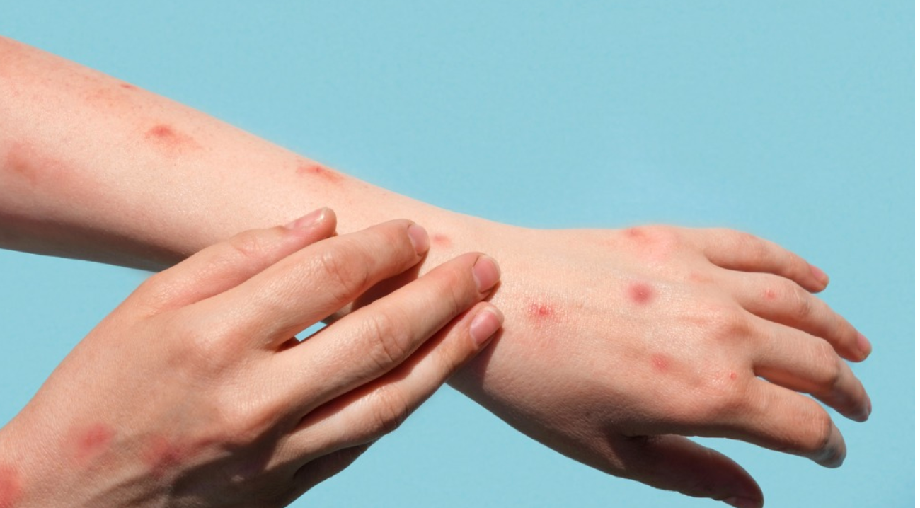 Monkeypox virus could become entrenched as a new STD in the US