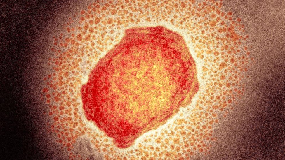 First monkeypox death reported in the US in ‘severely immunocompromised’ patient
