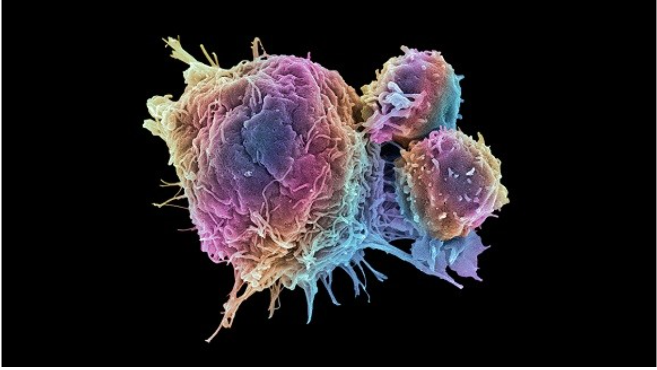 Global cancer cases on the rise among people under 50: Study