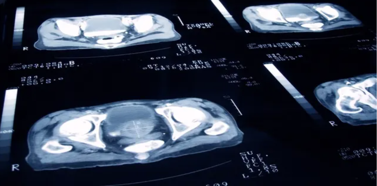 Mystery: A cancer patient in the US developed an ‘uncontrollable’ Irish accent