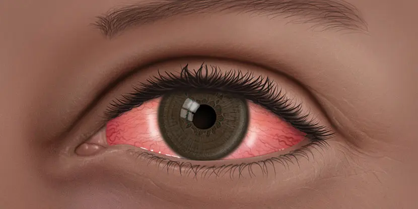 Conjunctivitis becoming a symptom of Covid in children: Report