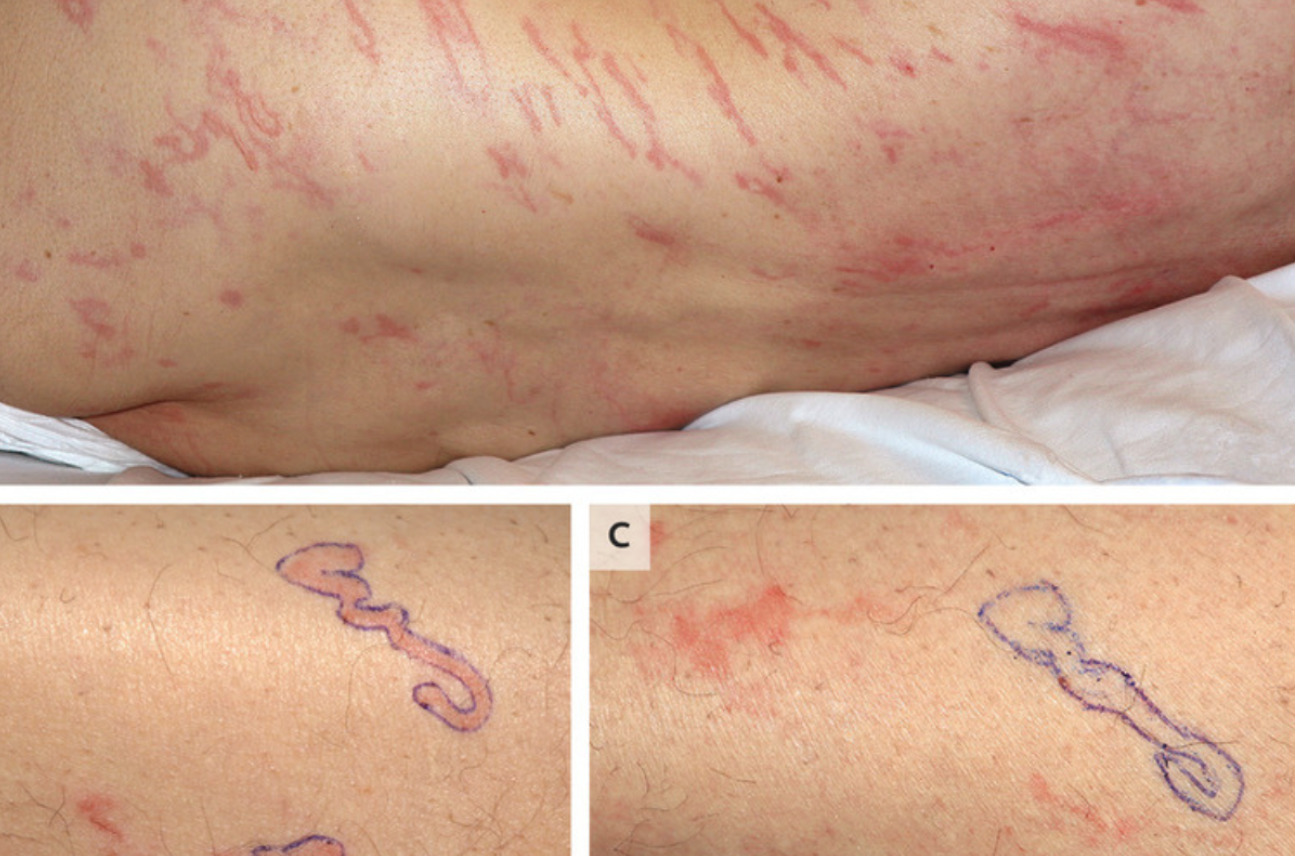 Worms seen crawling under man’s skin in a rare case in Spain