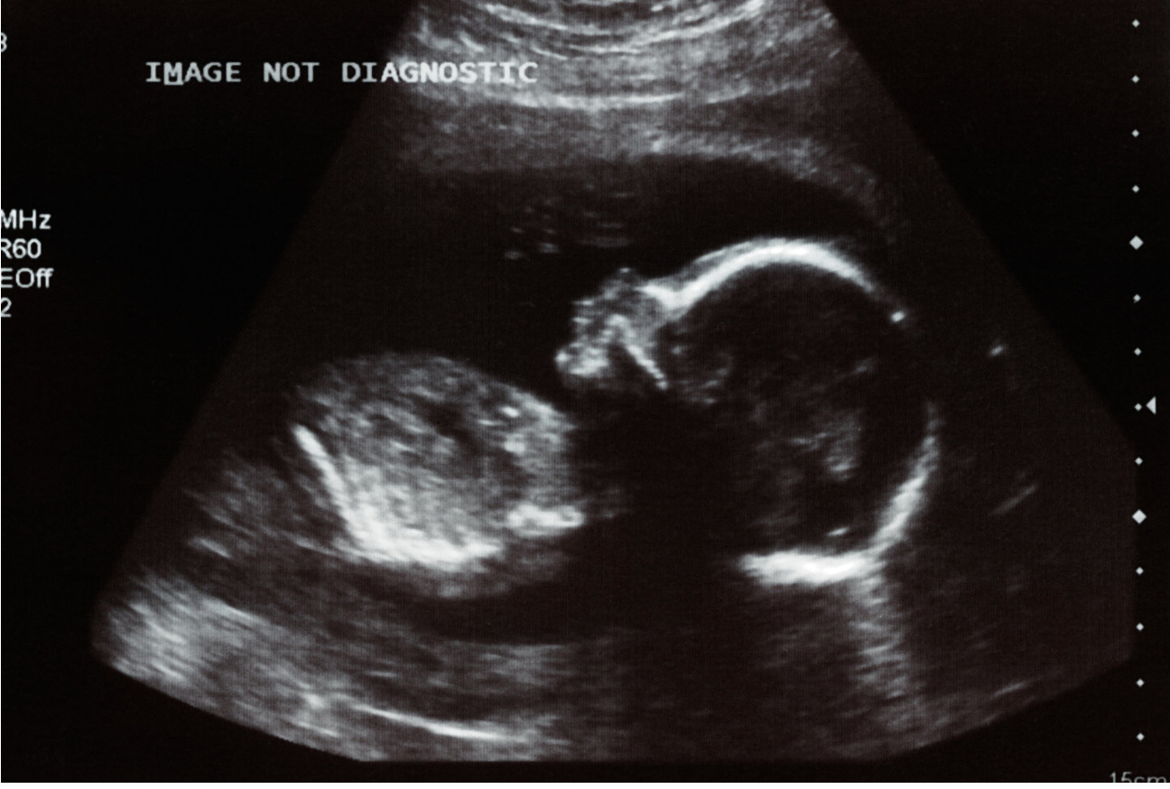COVID-19 caused brain damage in 2 infants infected during pregnancy- Study