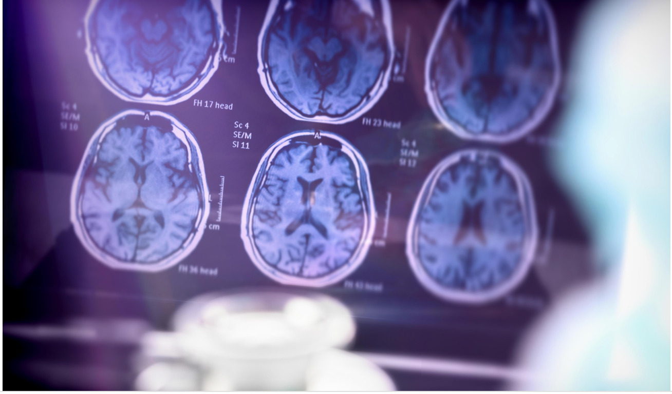 Study reveals sleeping pills help lower Alzheimer’s protein levels