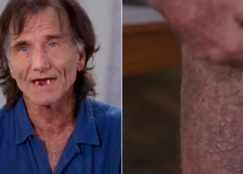 Challenges of a man with “crocodile-like skin”: “clothes hurt so much”