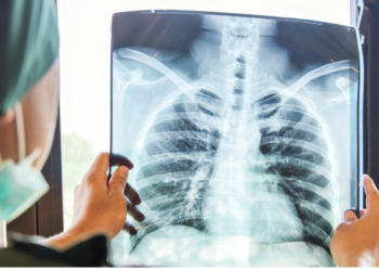 Washington state: Woman arrested after refusing tuberculosis treatment for more than a year