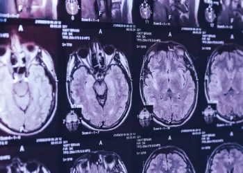 Canada: A mysterious brain illness is spreading in New Brunswick and many young people show no symptoms