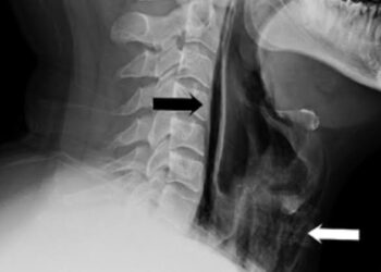 In the world’s 1st known case, man tears windpipe from holding his sneeze