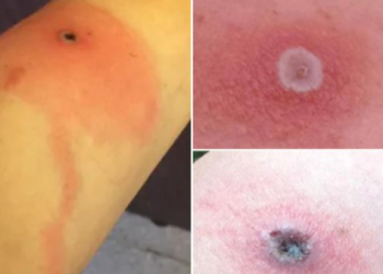 What is Alaskapox? Virus claims first life in the US