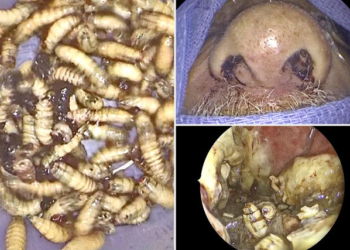 Shocking discovery: Florida doctor removes 150 live bugs from man’s inflamed face