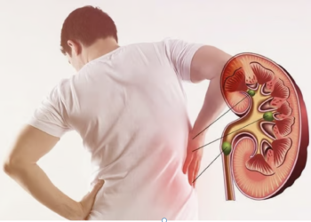 Google SGE’s AI advises drinking urine to pass kidney stones quickly