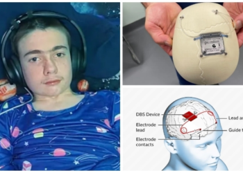 epilepsy