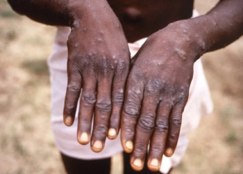 Experts warn of ‘most dangerous’ mpox strain spreading in Democratic Republic of the Congo