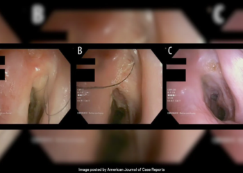 Austrian man develops rare condition of hair growth inside throat due to smoking