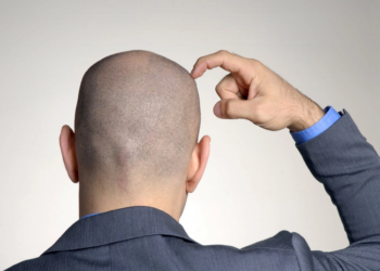 Accidental discovery: Major breakthrough in baldness treatment; sugar gel found to stimulate hair regrowth
