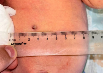 Bizarre: Baby born with rifle pellet in stomach after the mother was shot by dad during her pregnancy