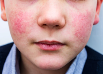 Rise in Parvovirus B19 cases among U.S. children prompts CDC warning