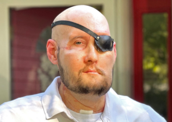 US veteran makes remarkable progress after world’s first eye transplant
