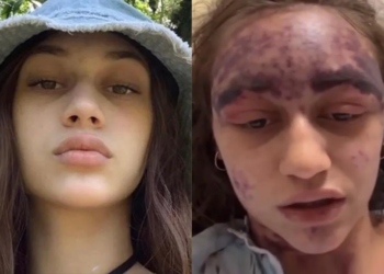 Florida woman, 23, battles critical health crisis after life-threatening vaccine reaction in California
