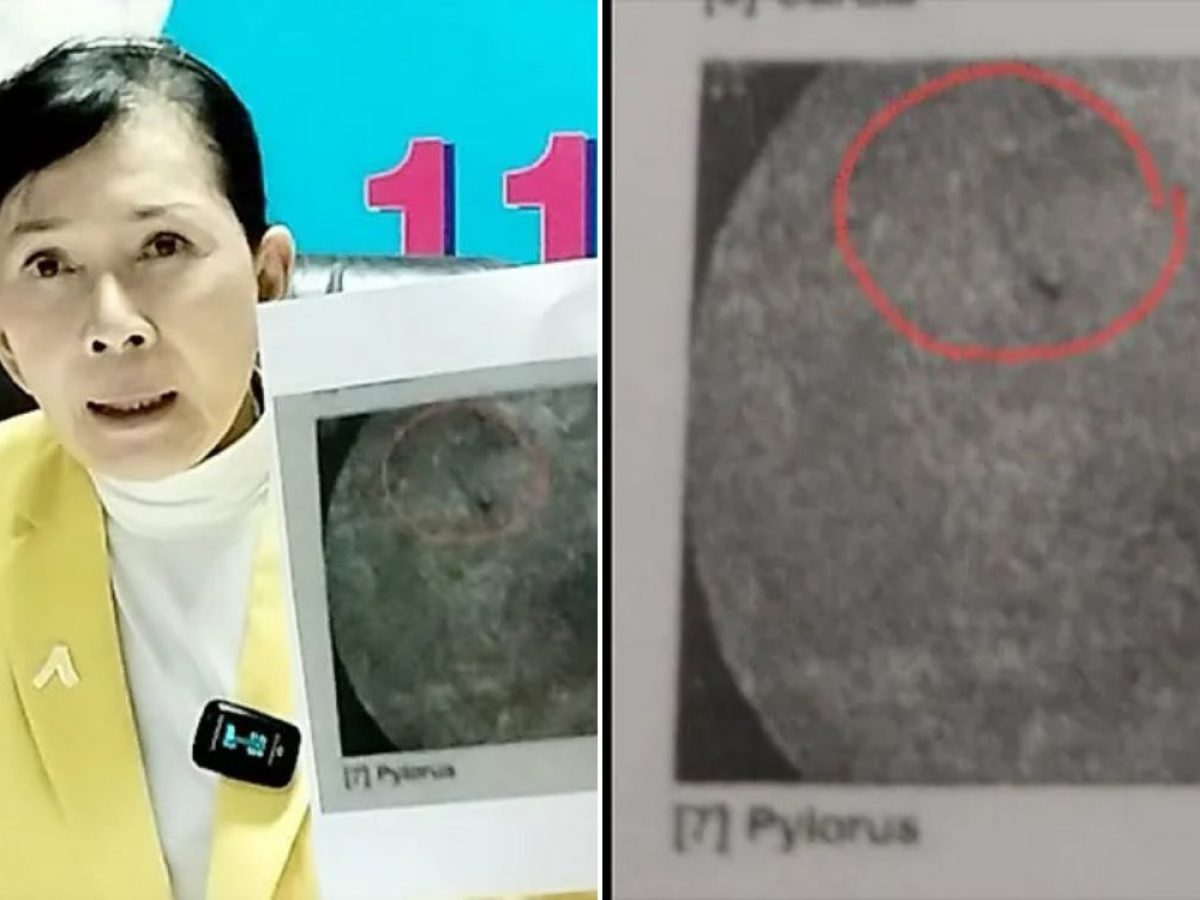 Thai woman finds needle left in vagina during childbirth, 18 years ...