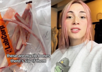 Kansas City trans woman who spent $17K on rib removal surgery plans to turn bones into crown