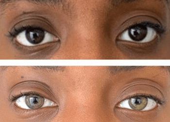 Permanent eye color change surgery: The latest beauty trend sweeping the US—how it works