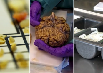 Human brains contain a spoon’s worth of nanoplastics, new study suggests