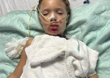 TikTok challenge leaves 7-year-old Missouri girl in coma with severe burns