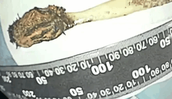 Man Lives 52 Years With Swallowed Toothbrush Lodged In Intestine, Baffles Doctors