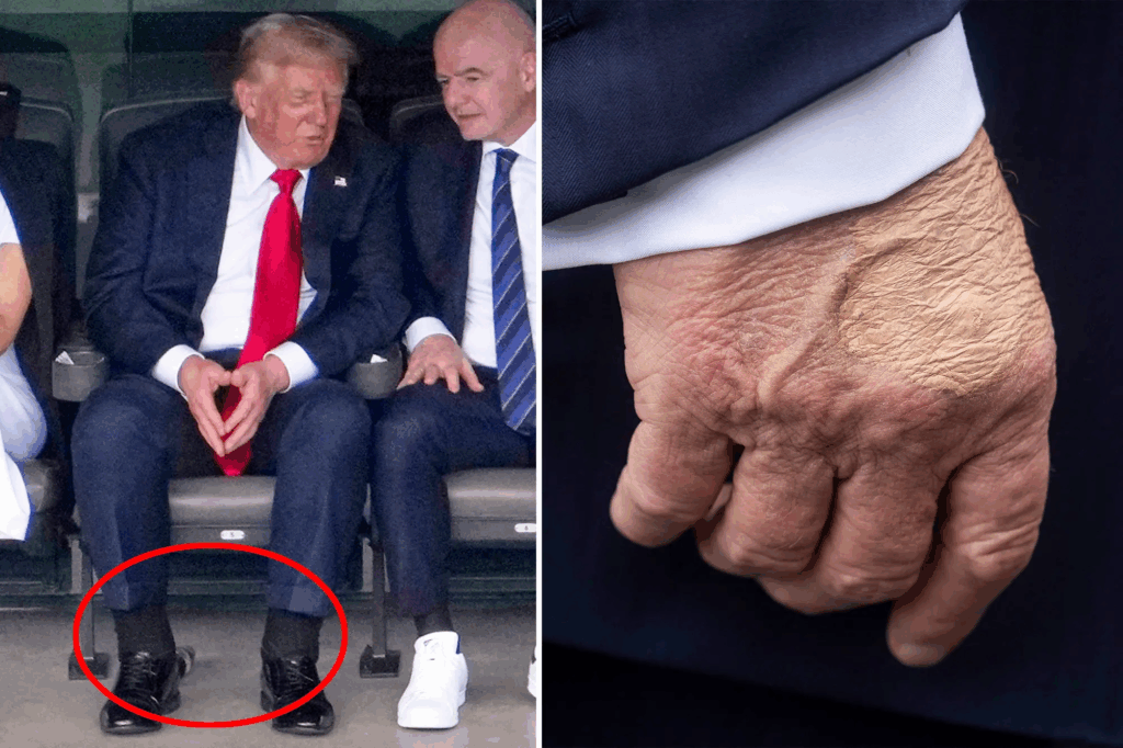 What Is Chronic Venous Insufficiency? Trump’s Diagnosis Explained