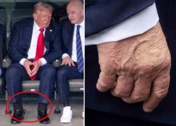 What Is Chronic Venous Insufficiency? Trump’s Diagnosis Explained