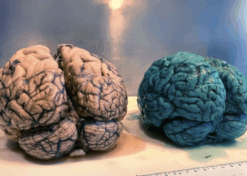Blue OrgansDoctors in Frankfurt found blue brains, hearts, and lungs during autopsies. The culprit: methylene blue, a drug used for malaria, infections, and emergency oxygen delivery. Even tiny doses (25 mg) can stain organs. The discoloration is not linked to death, but it complicates autopsies. The study highlights how old drugs can still surprise us—sometimes in living color.