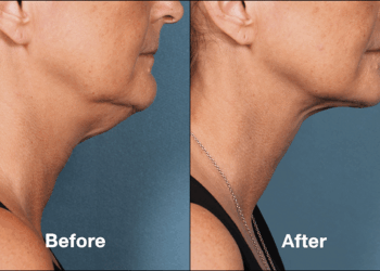 Face-Slimming Procedure