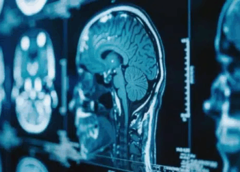 Gene Therapy Slows Huntington’s Disease by 75% In Breakthrough Trial