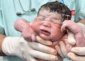 Miracle or Fluke? Baby in Brazil Born Holding Mother’s Contraceptive IUD