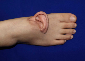 Chinese Surgeons Graft Severed Ear to Patient’s Foot, Reattach It Months Later