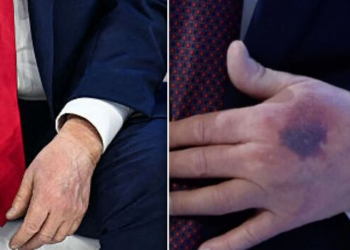 What Is That Blue Bruise on US President’s Hand? Trump Breaks His Silence