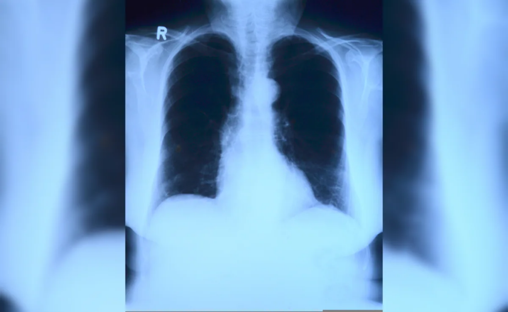 Does AI guess X-ray Results Instead of Reading Them? A Closer Look At The “Mirage Effect”