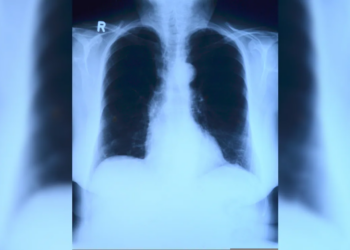 Does AI guess X-ray Results Instead of Reading Them? A Closer Look At The “Mirage Effect”