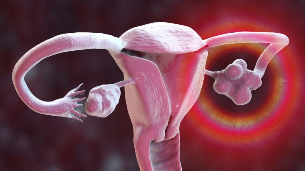 PCOS Is Now PMOS: Why This One-Letter Name Change Could Transform Women’s Healthcare