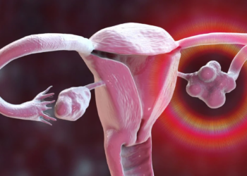 PCOS